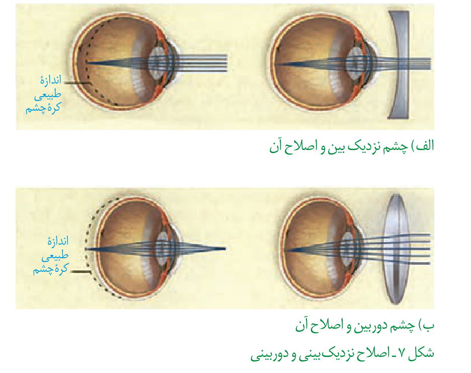 اصلاح نزدیکبینی با عدسی واگرا و دوربینی با عدسی همگرا؛ اندازهٔ طبیعی کرهٔ چشم در هر دو ردیف مشخص شده است
